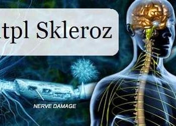 Multipl Skleroz (MS) hastalığı neden olur? Belirtileri ve tedavisi