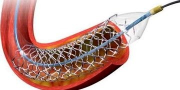 10 soruda stent uygulaması hakkında merak edilen herşey