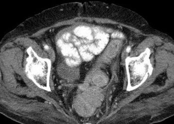 Yumuşak doku tümörleri (sarkomlar) tanı ve tedavisi