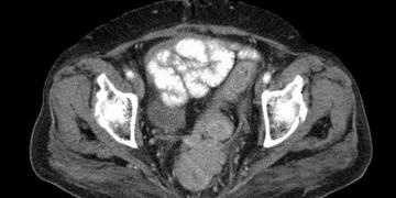 Yumuşak doku tümörleri (sarkomlar) tanı ve tedavisi