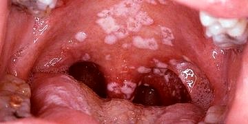 Ağız mantarı neden olur? Belirtileri ve tedavisi