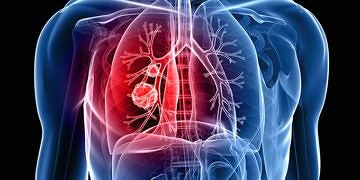 Türkiye’de akciğer kanserinin yaygınlığı, seyri ve tanı yöntemleri…