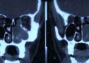 Burun ve paranazal sinüs  tümörlerinin tanı ve tedavisi