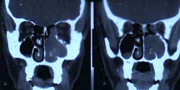 Burun ve paranazal sinüs  tümörlerinin tanı ve tedavisi