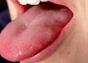 Oral kavite mukoza hastalıkları tanı ve tedavisi