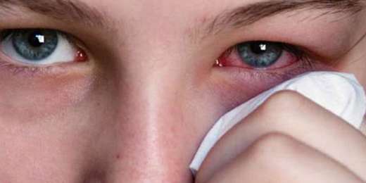 göz alerjisi damlaları nedenleri tedavisi