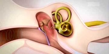 Ototoksisite nedir, tedavisi ve ototoksisite yapan ilaçlar