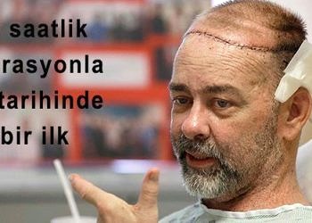 Dünyanın ilk kafatası nakli operasyonu ABD’de başarıyla yapıldı