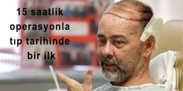 Dünyanın ilk kafatası nakli operasyonu ABD’de başarıyla yapıldı