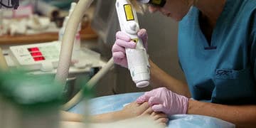 Lazer teknolojisi ile tırnak mantarı tedavisi