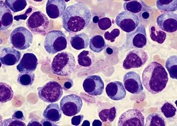 Transplantasyona uygun olmayan Miyelom hastalar için yeni tedaviler