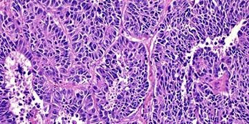 Nöroendokrin tümörlerin erken teşhisi tedavi için çok önemli