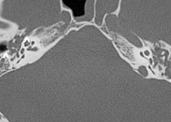 Temporal kemik fraktürleri