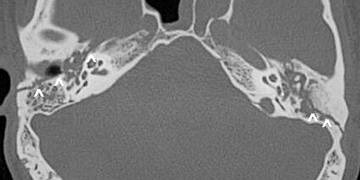 Temporal kemik fraktürleri
