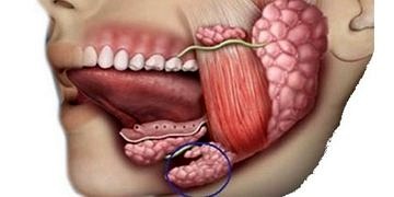 Tükürük bezlerinin şişmesinin yarattığı sorunlar ve tedavisi