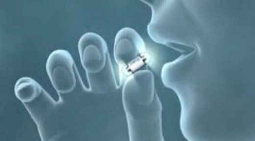 ince-bagirsak-hastaliklarina-kamerali-teshis-kapsul-endoskopi