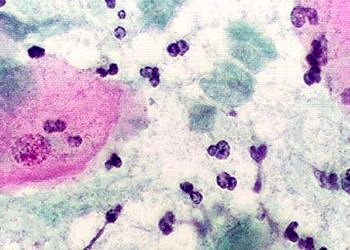 Dientamoebiasis nedir? Brlirti, tanı ve tedavisi