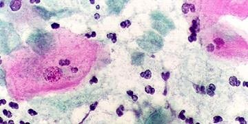 Dientamoebiasis nedir? Brlirti, tanı ve tedavisi