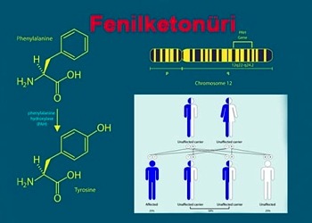 Fenilketonüri (PKU) nedir? Nedenleri, belirtileri, tedavisi ve diyeti