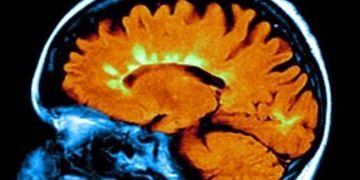 D vitamini eksikliği MS’e neden olabilir