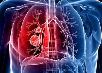 Ebus bronkoskopisi ile akciğer hastalıklarının teşhisinde büyük başarı