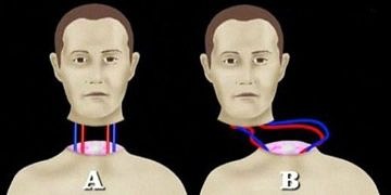 Tarihin en heyecan verici cerrahi işlemi: Tam vücut nakli yapılacak mı?