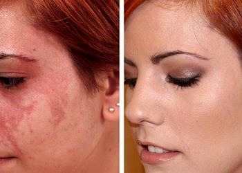 Cilt lekelerinden kurtulmak için Pulse Dye Lazer