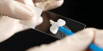 Böbrek kanseri için kullanılan ilaç rahim ağzı kanserinde ömrü uzatıyor