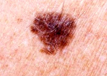 Sağ koldaki benlerin kanser riski için özel bir anlamı mı var?