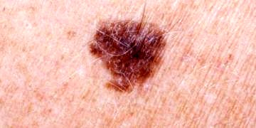 Sağ koldaki benlerin kanser riski için özel bir anlamı mı var?