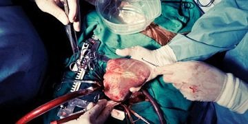 Açık kalp ameliyatı yapan cerrah nesli hızla tükeniyor!