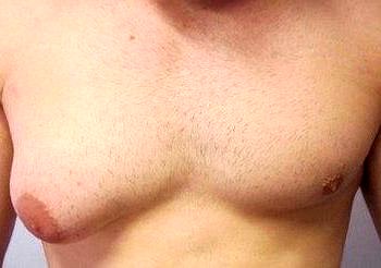 Erkeklerde meme büyümesinin nedenleri ve tedavisi