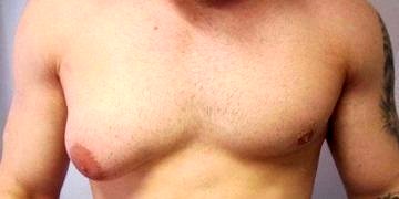 Erkeklerde meme büyümesinin nedenleri ve tedavisi