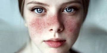 Lupus hastalığı nedir? Kimlerde görülür? Belirtileri ve tedavisi