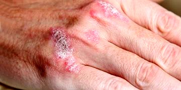 Sedef soğuk ülkelerde, daha sık görülüyor!