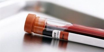 Kanserin türünü bir damla kanla %96 doğrulukla tespit eden test