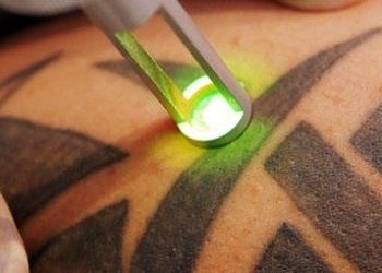 İstenmeyen dövmeler için lazerle dövme sildirme teknolojisi