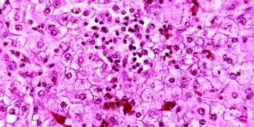 Amibik apse nedir? Belirtileri, tanı ve tedavisi