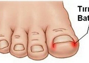 Tırnak batmasının nedenleri ve tedavisi…