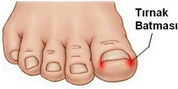 Tırnak batmasının nedenleri ve tedavisi…