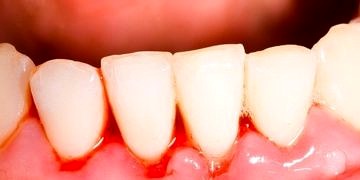 Diş eti kanaması nasıl önlenir?