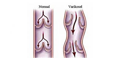 Varikosel