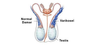 Varikosel nedir? Neden olur? Belirtileri, tedavisi ve ameliyatı