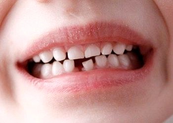 Çocuklarda süt dişinin ihmal edilmesi, çarpık dişlere neden oluyor