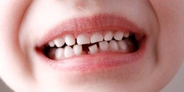Çocuklarda süt dişinin ihmal edilmesi, çarpık dişlere neden oluyor