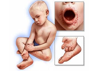 El-ayak-ağız hastalığı nedir? Belirtileri, nedenleri ve tedavisi