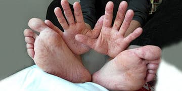 El-ayak-ağız hastalığı nedir? Belirtileri, nedenleri ve tedavisi