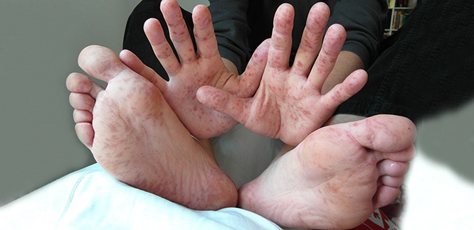 el ayak agiz hastaliginin en yuksek bulasma riski dokuntu doneminde oluyor