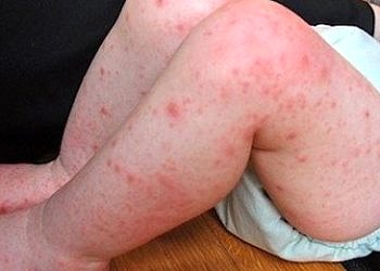 El-ayak-ağız hastalığı nedir? Belirtileri, nedenleri ve tedavisi