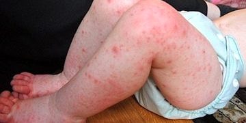 El-ayak-ağız hastalığı nedir? Belirtileri, nedenleri ve tedavisi